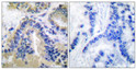 Immunohistochemistry analysis of paraffin-embedded human lung carcinoma tissue, using Caspase 10 Antibody. The picture on the right is blocked with the synthesized peptide.